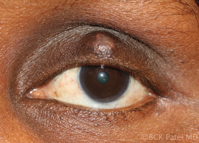 Chalazion in an African American male by Dr. BCK Patel MD, FRCS