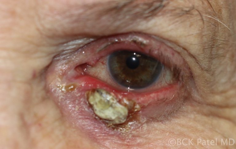 Chronic chalazion with calcification by Dr. BCK Patel MD, FRCS