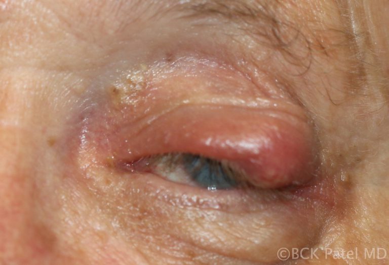 Cellulitis secondary to a chalazion by Dr. BCK Patel MD, FRCS