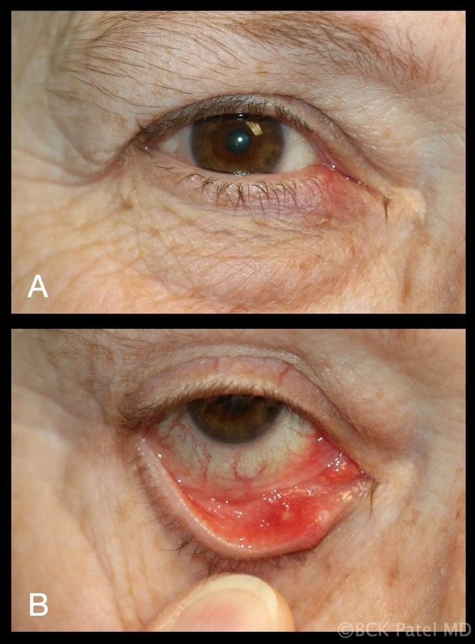 Posterior hordeolum or chalazion by Dr. BCK Patel MD, FRCS