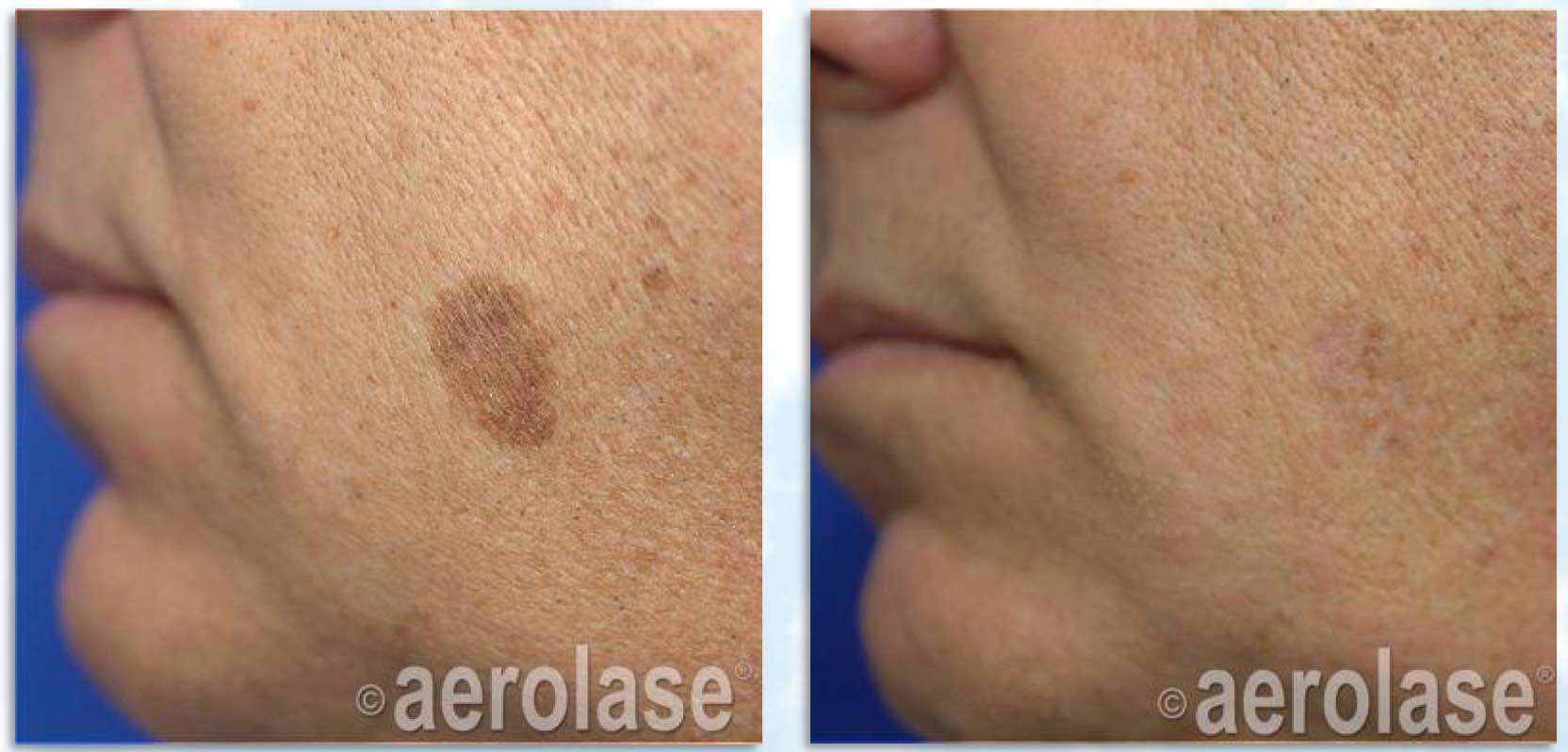 Treatment of facial pigment spot with the Aerolase Neo laser Dr BCK Patel MD, FRCS Plastic Surgeon Salt Lake City and St George UtahPicturePicture