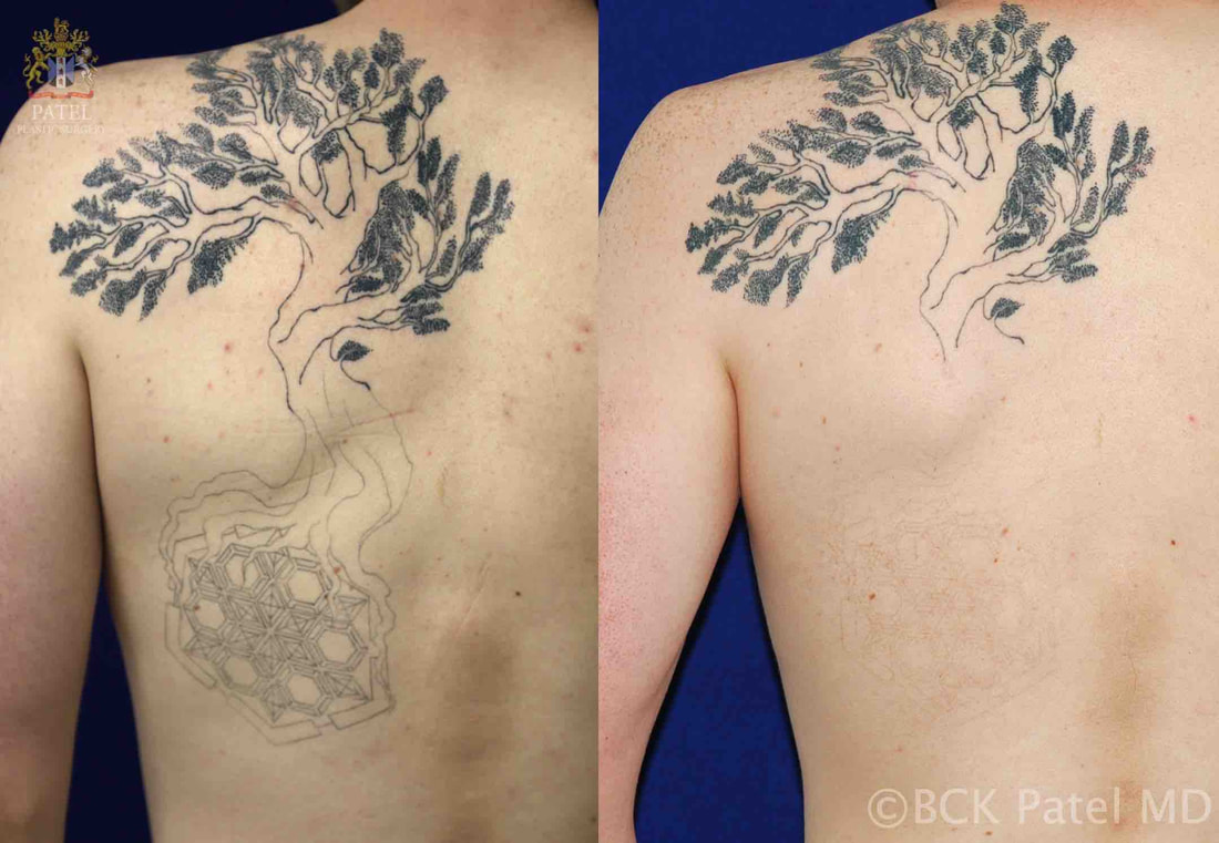 Advanced Picosecond Laser Tattoo removal by Dr. BCK Patel, Salt Lake City, Utah