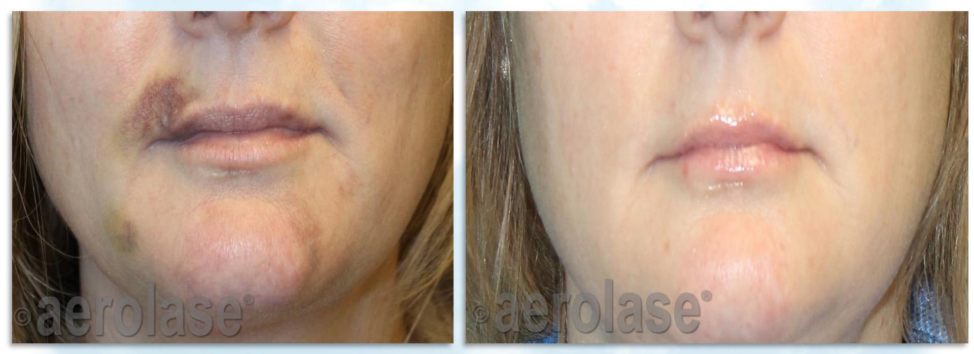 Treatment of facial bruising with Aerolase Neo laser Dr BCK Patel MD, FRCS Plastic Surgeon Salt Lake City and St George UtahPicturePicture