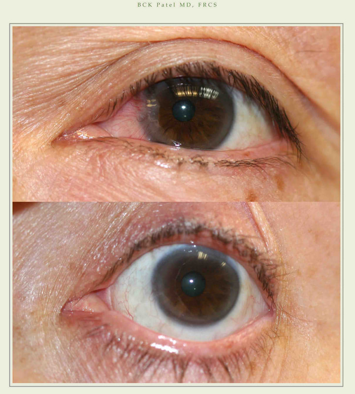 Before-and-after photos of left pterygium removal and repair with tissue glue and free conjunctival graft by Dr. BCK Patel MD, FRCS
