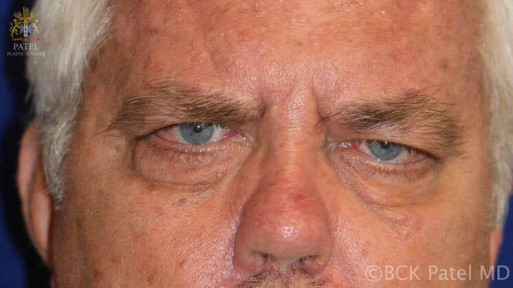 Advanced myasthenia gravis with marked facial weakness: frontalis muscle weakness (brow ptosis), upper lid ptosis, lower lid laxity and ectropion and cheek ptosis with loss of facial expression by Prof. BCK Patel MD, FRCS