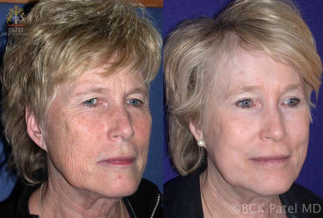Browlifts, upper and lower blepharoplasty, fat grafts and CO2 laser in a female showing marked cosmetic improvement of the face by Dr. Bhupendra C. K. Patel MD of Salt Lake City, and Saint George, Utah