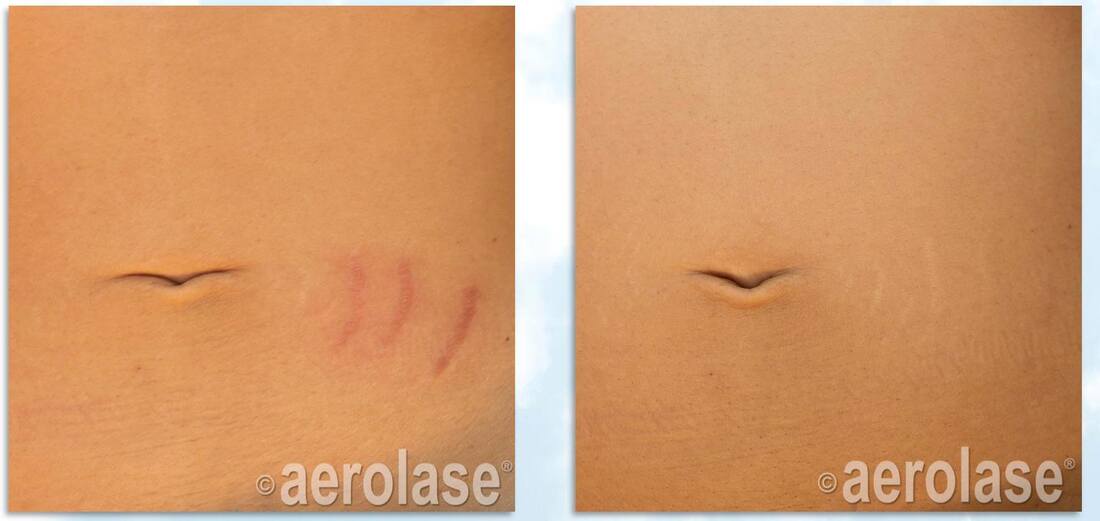 Scar revision and reduction of pinkness with the Aerolase Neo laser Dr BCK Patel MD, FRCS Plastic Surgeon Salt Lake City and St George UtahPicturePicture