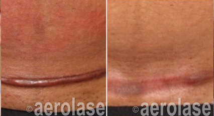 Aerolase Neo treatment of hypertrophic pink scar Dr. BCK Patel MD of Salt Lake City Plastic SurgeryPicture