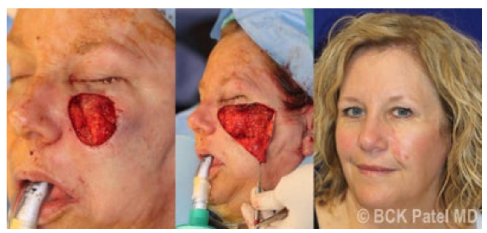 Facial melanoma reconstruction by Dr. BCK Patel MD, FRCS