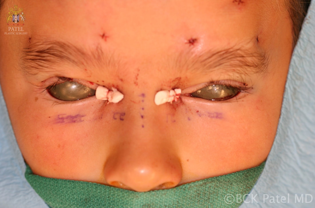 Frontalis slings with fascia lata and Patel modified medial canthoplasties for the Blepharophimosis syndrome