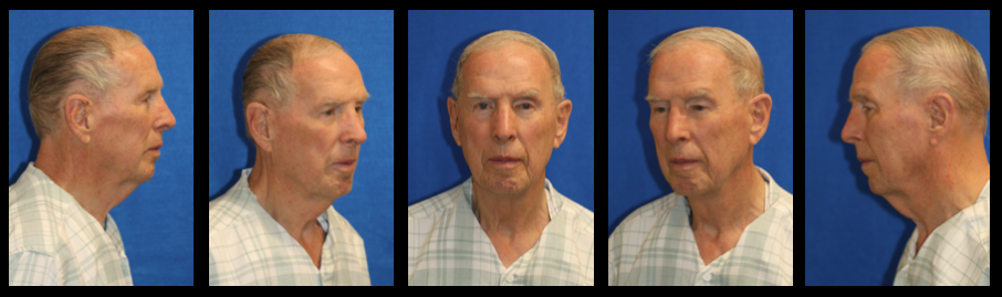 patel plastic surgery facelift male facelift and necklift