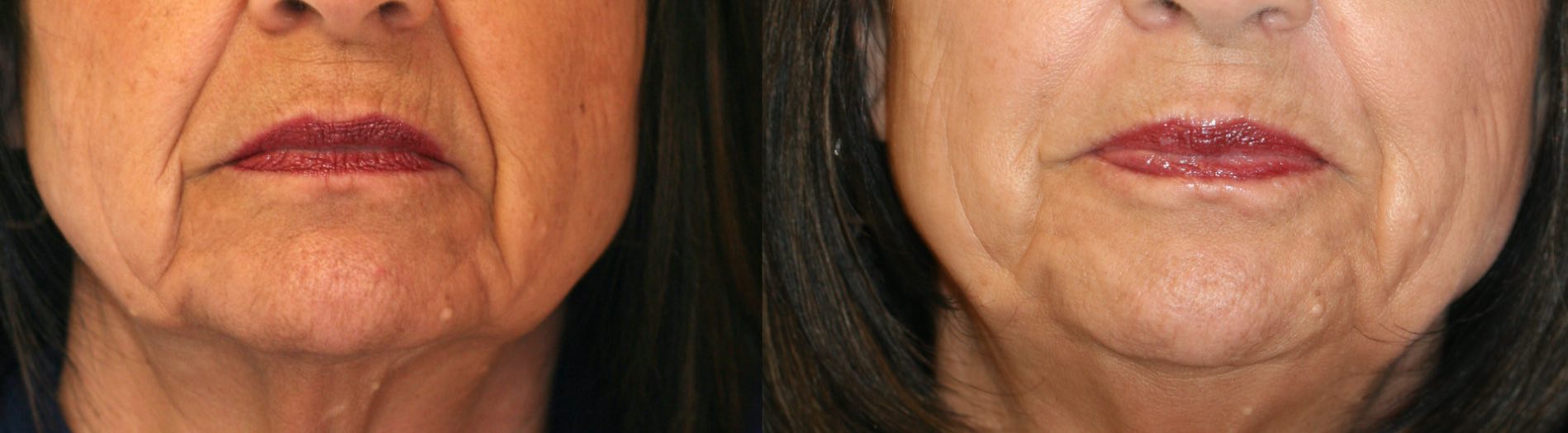 A combination of fillers into the nasolabial and melolabial folds and injection of the depressor anguli oris muscle gives a more relaxed mouth shape by Dr. BCK Patel MD, FRCS of Salt Lake City and St. George, Utah
