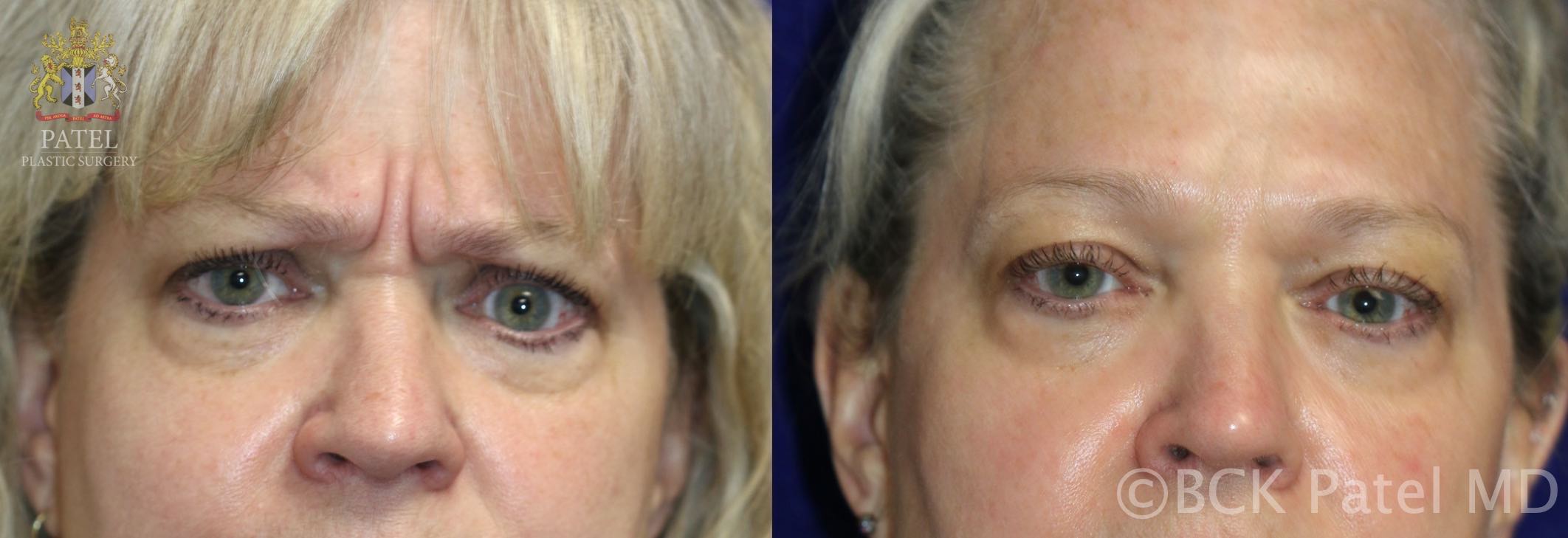 Impressive results with properly injected botox into the procerus and corrugator muscles by Dr. BCK Patel MD, FRCS