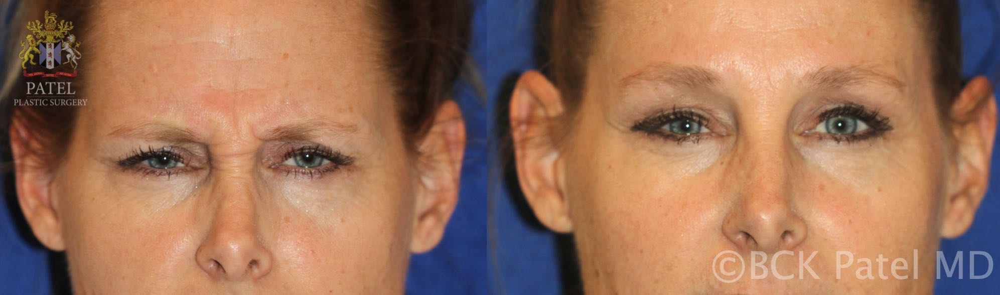 Patient frowning before (left) and after (right) injection with botulinum toxin into the corrugator and procerus muscles. Note the improvement in the shape and height of the brows. By Dr. BCK Patel MD, FRCS