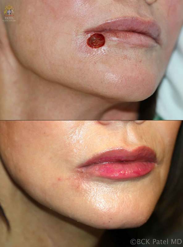 Lip lines before after surgery