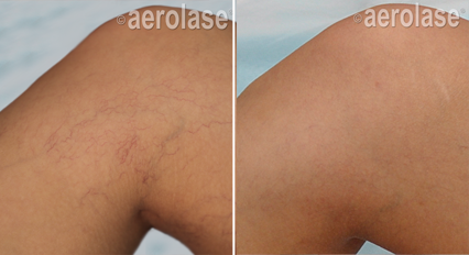 Treatment of leg spider veins with the Aerolase Neo Dr BCK Patel, Plastic Surgeon, Salt Lake CityPicture