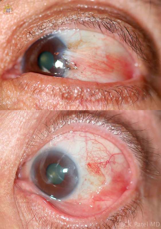 Before and after photograph of pterygium resection and free conjunctival graft by Dr. Bhupendra C. K. Patel MD