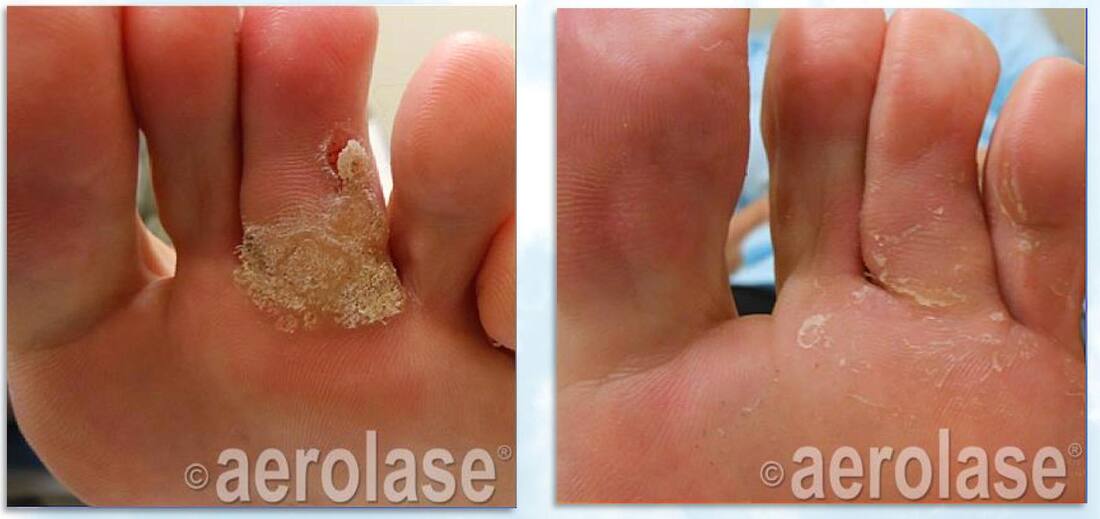 Treatment of foot and toe warts with the Aerolase Neo laser Dr BCK Patel MD, FRCS Plastic Surgeon Salt Lake City and St George UtahPicturePicture