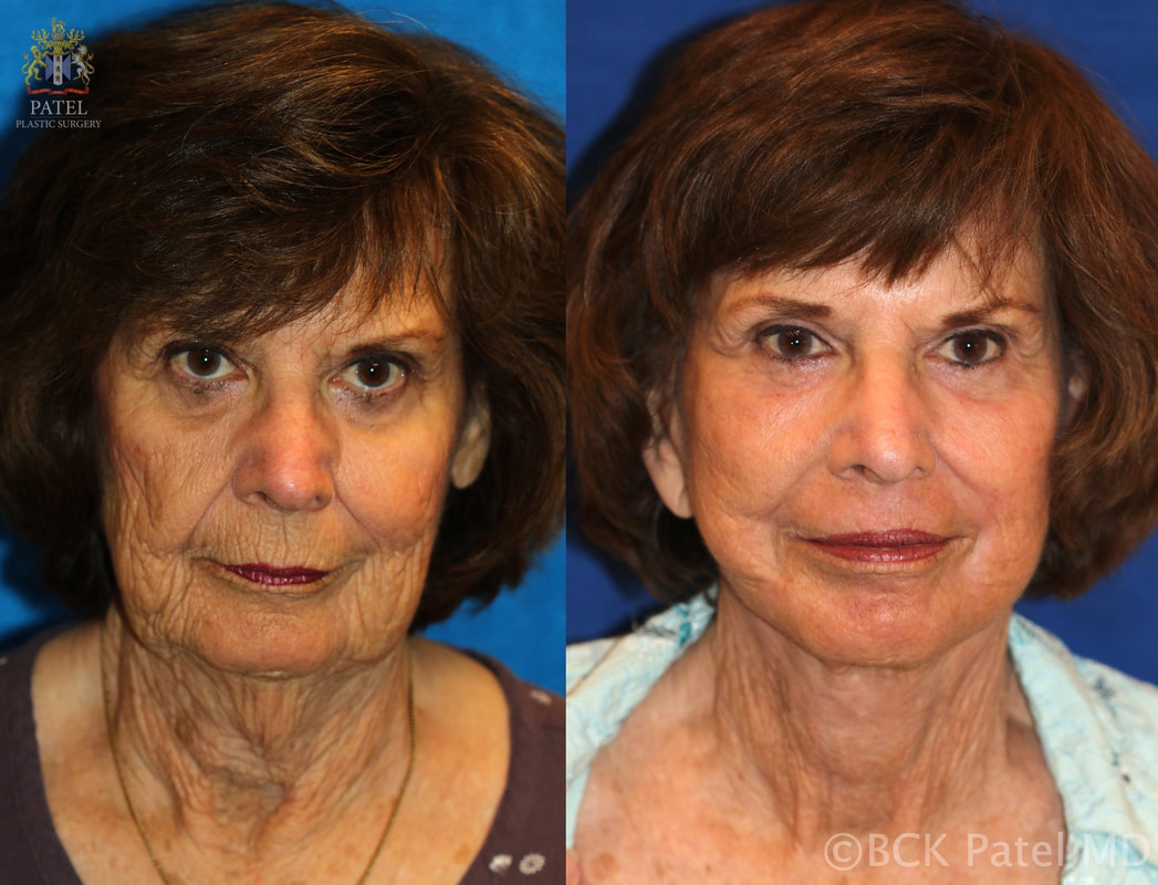 Facelift and necklift by Dr. BCK Patel MD of Salt Lake City and St. George 