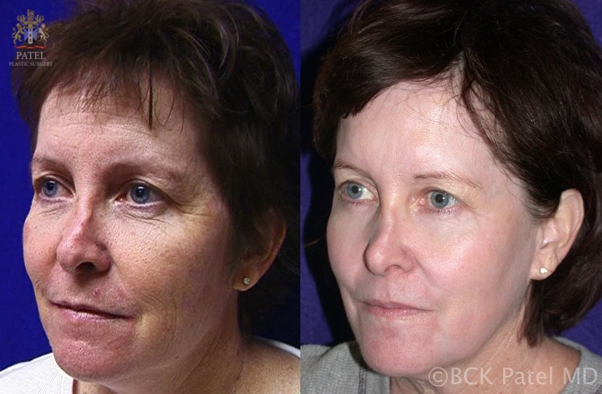 CO2 fractionated laser to the full face showing a nice improvement in the skin color, facial wrinkles and overall appearance of the face. By Dr. Bhupendra C. K. Patel MD of Salt Lake City and Saint George, Utah