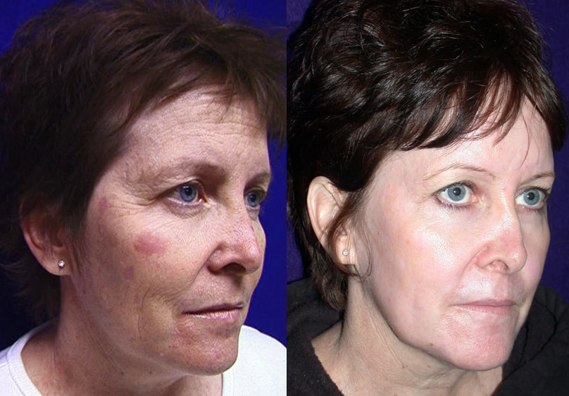 Results of CO2 Laser to the face showing improvment in the skin, tone, texture, wrinkles by Dr. BCK Patel MD, FRCS of Salt Lake City, Utah, St. George, Utah and London, England