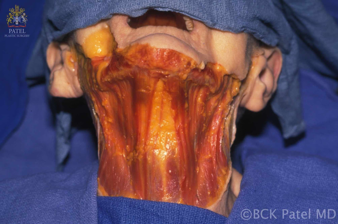 Anatomy of the Platysma: platysma bands can be seen in this older-aged specimen by Dr. BCK Patel MD, FRCS