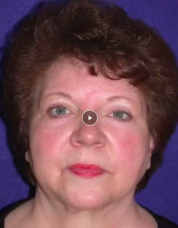 63 Yrs Old with Droopy brows and eyelids