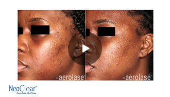 NeoClear by Aerolase Laser Acne Therapy