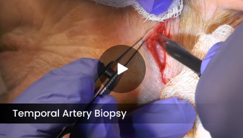 Temporal Artery Biopsy