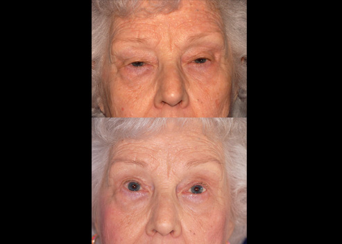 adair-patricia-pre-post-ptosis-2_orig