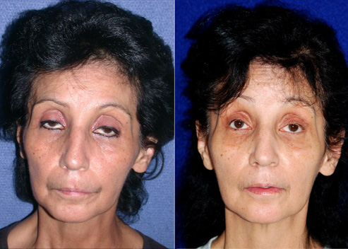 albo-thelma-pre-post-1a_orig