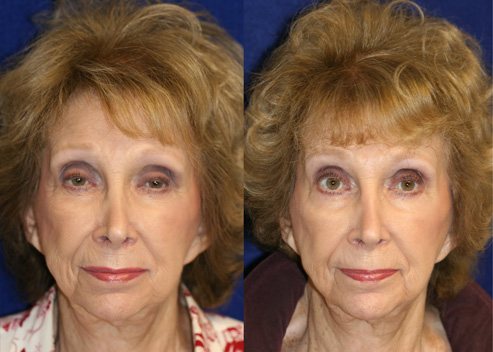 albrecht-jane-pre-post-1_orig