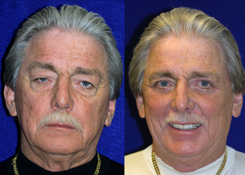 aubrey-bill-pre-post-1a_orig