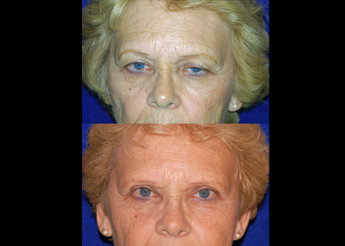 babb-patricia-pre-post-2aq_orig