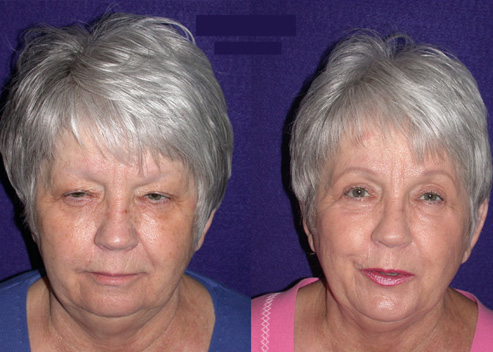 beus-connie-pre-post_orig