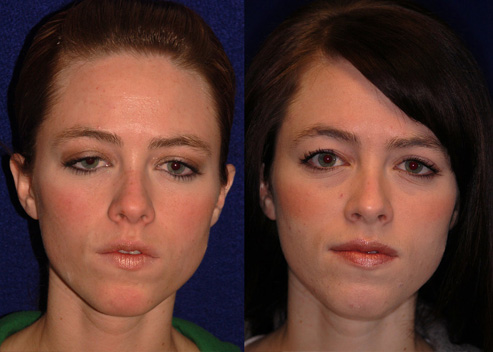 burrell-kate-pre-post_orig