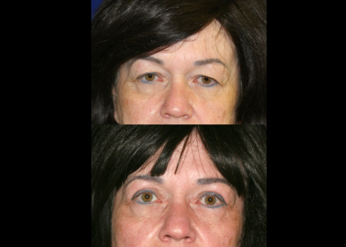 burton-vonnie-pre-post-2_1_orig