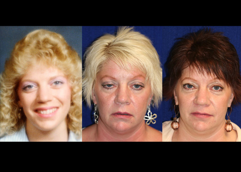 butcher-cynthia-pre-post-2_orig