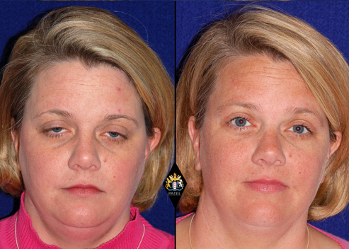 fuller-lisa-pre-post-ptosis-1a_orig