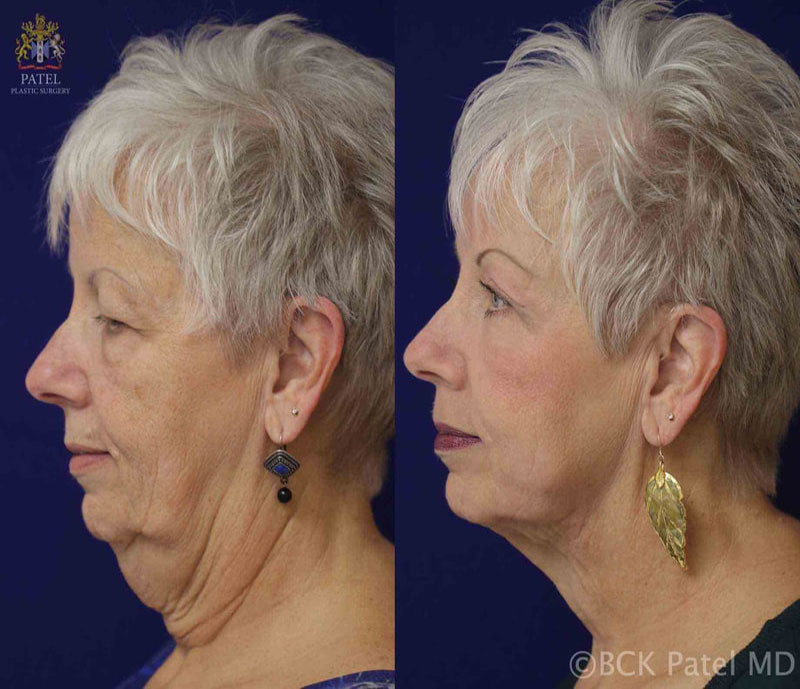 morelli-jackie-pre-post-hammock-1