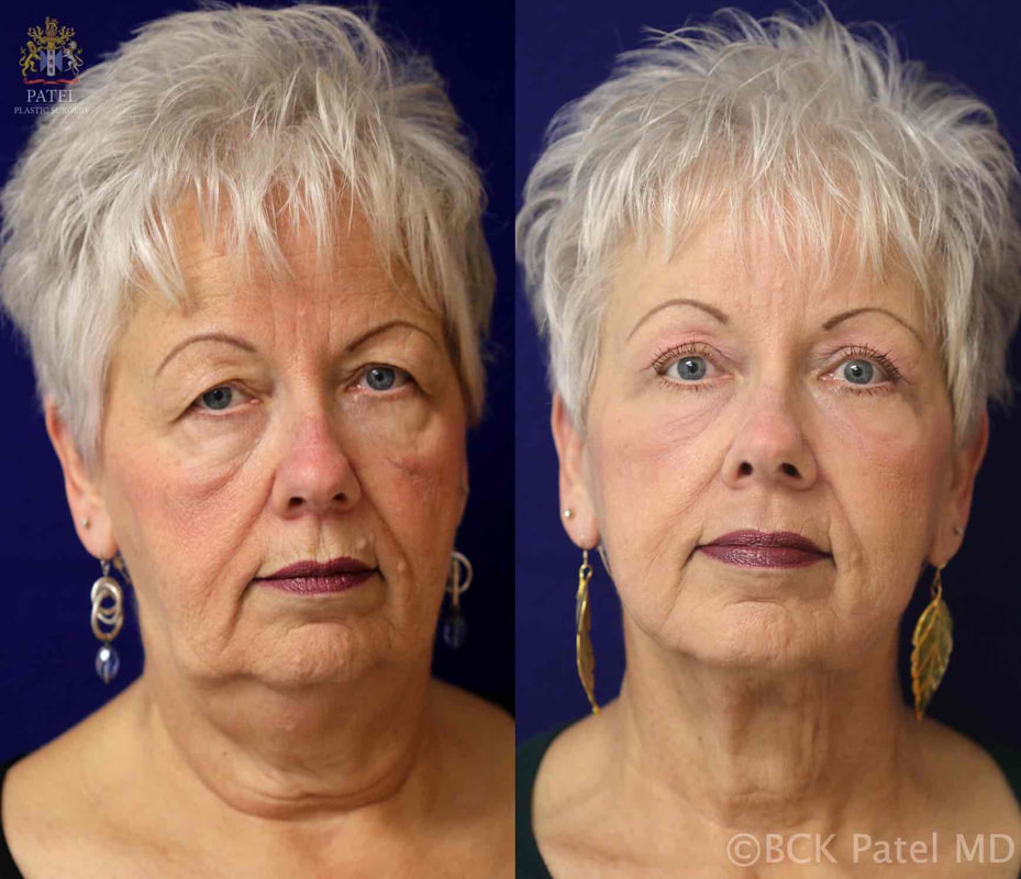 morelli-jackie-pre-post-hammock-2_orig