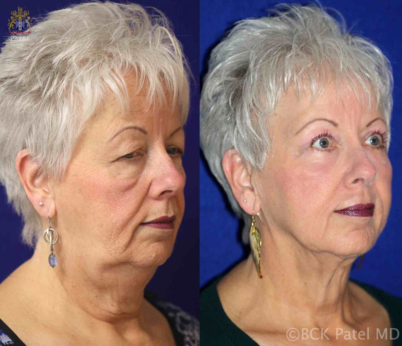 morelli-jackie-pre-post-hammock-3