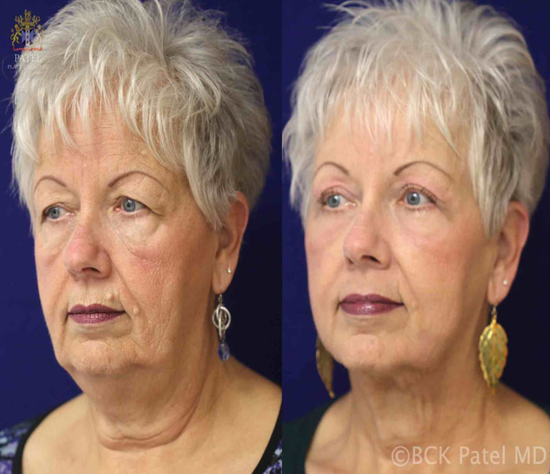 morelli-jackie-pre-post-hammock-4