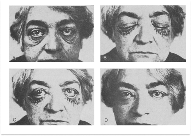 noel-lower-blepharoplasty