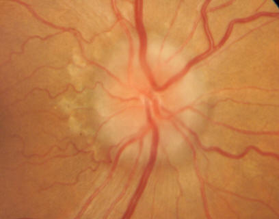optic-disc-edema_orig