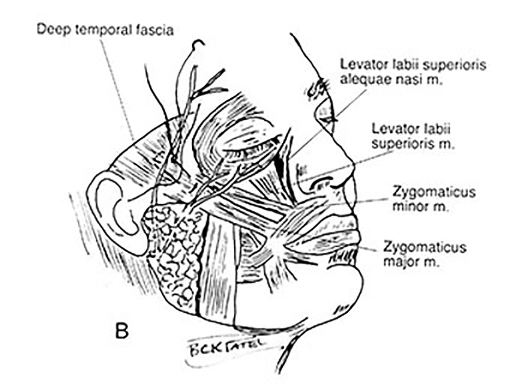 Principles of the Hammock Lift: shows how we reposition tissues to reverse the changes seen with aging. There is an improvement in the forehead, the brows, the upper and lower eyelids and cheeks and the skin is treated with a combination of fractionated lasers and nano fat grafts. Procedure designed by Dr. BCK Patel MD, FRCS