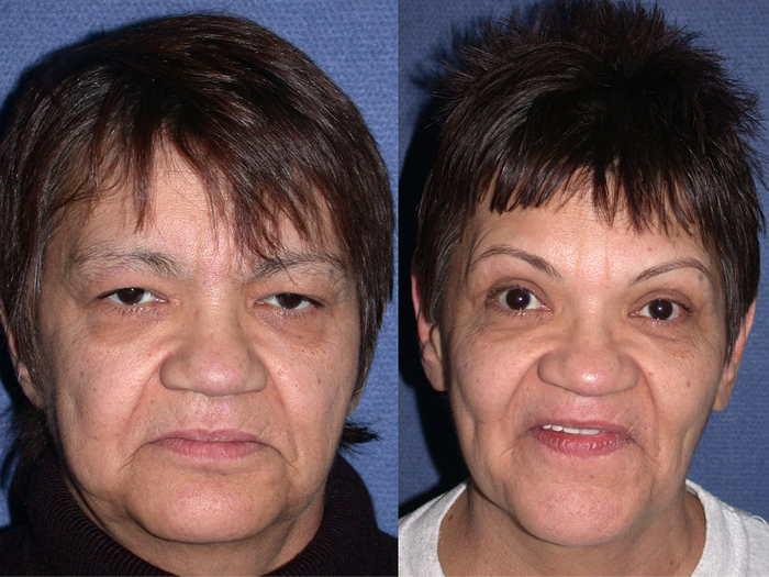 stevenson erlinda pre post