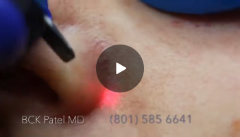 Laser Treatment of Face Veins