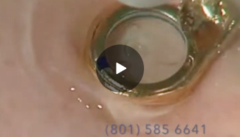 Leg Vein Laser Treatments