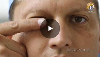 Lower Eyelid Pressure Upwards